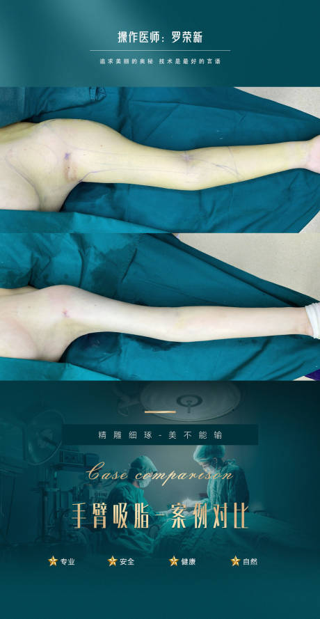 源文件下載【醫美手臂抽脂案例海報】編號：88420020426743350
