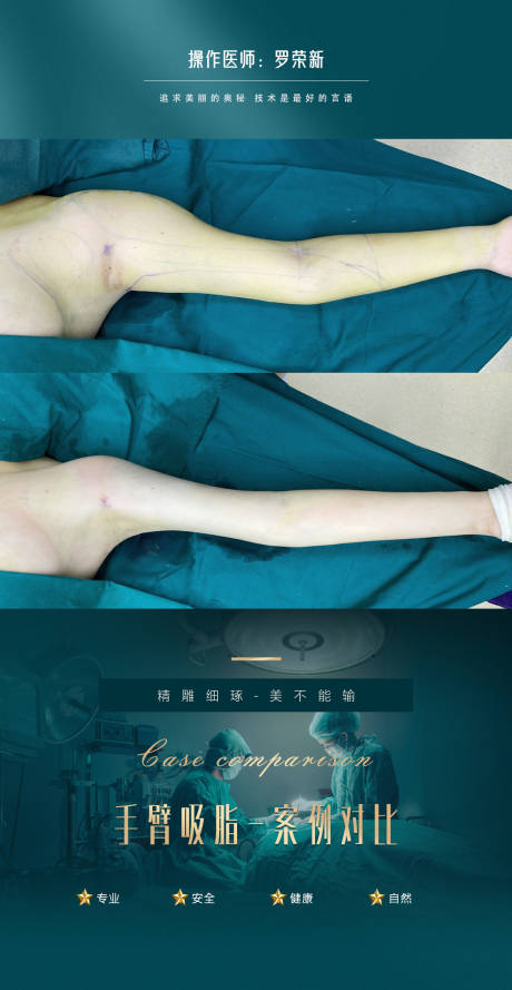 编号：20231116103813359【享设计】源文件下载-医美手臂抽脂案例海报