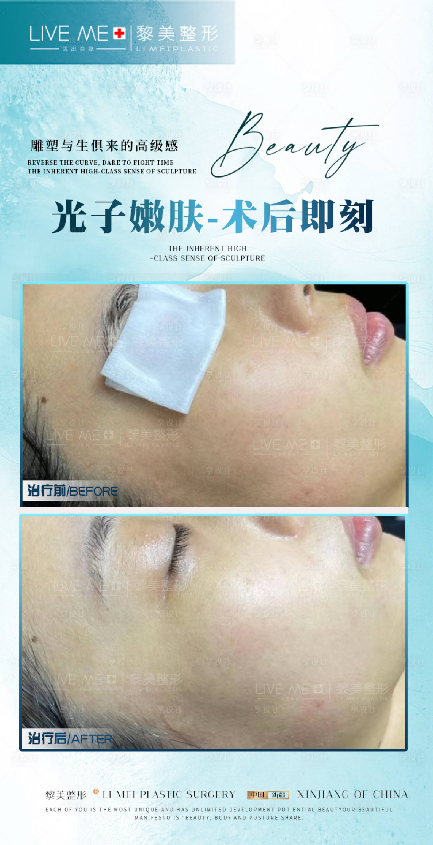 源文件下载【享设计】搜索编号：87880020408204337【光子嫩肤案例】