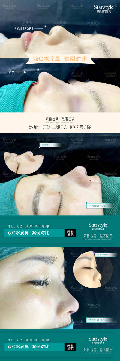 源文件下载【医美隆鼻案例海报】编号：76350020687325024