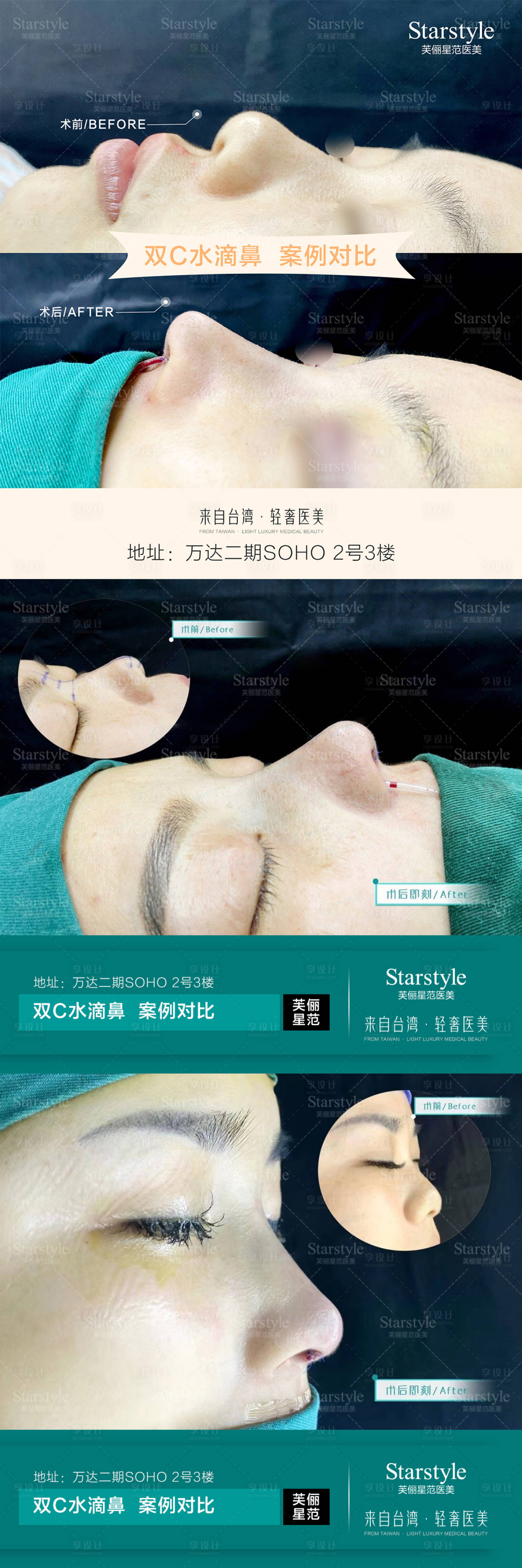 源文件下載【享設(shè)計(jì)】搜索編號：76350020687325024【醫(yī)美隆鼻案例海報】