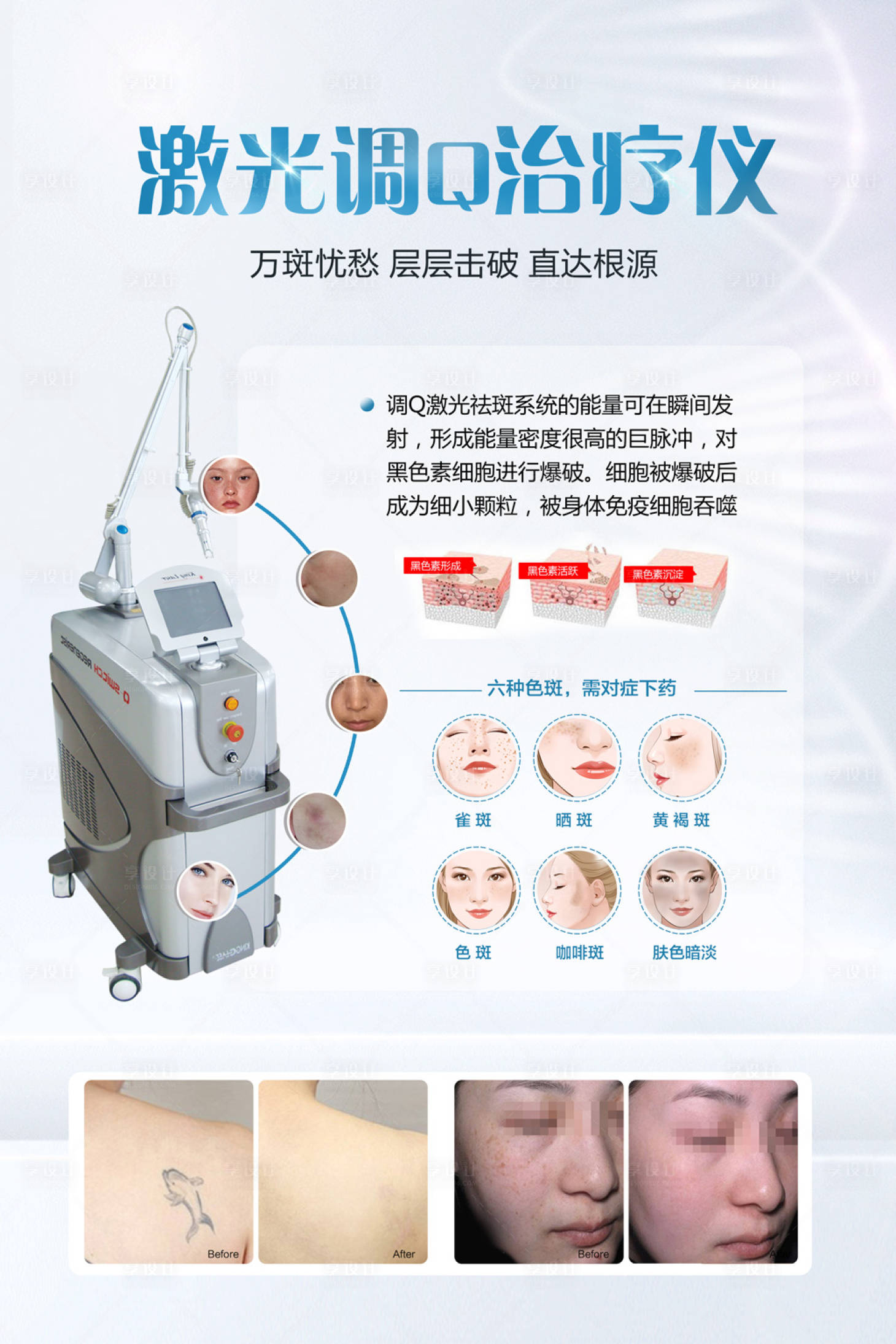 源文件下载【激光调Q治疗仪案例对比海报】编号：90890020780917834