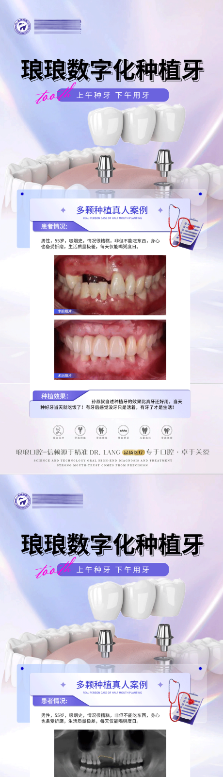 源文件下載【享設計】搜索編號：60610020764051968【口腔種植案例海報】