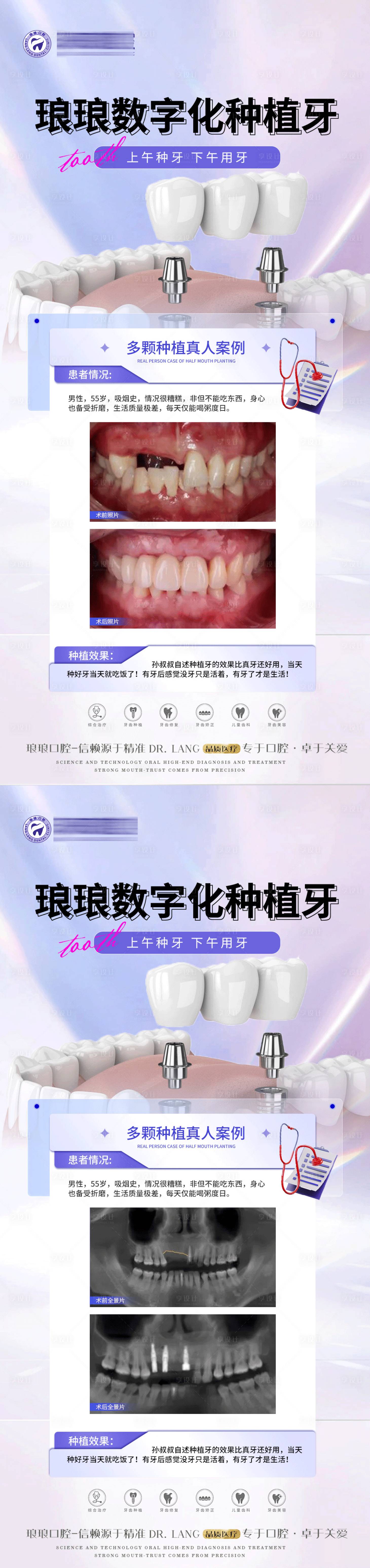 源文件下載【享設計】搜索編號：60610020764051968【口腔種植案例海報】