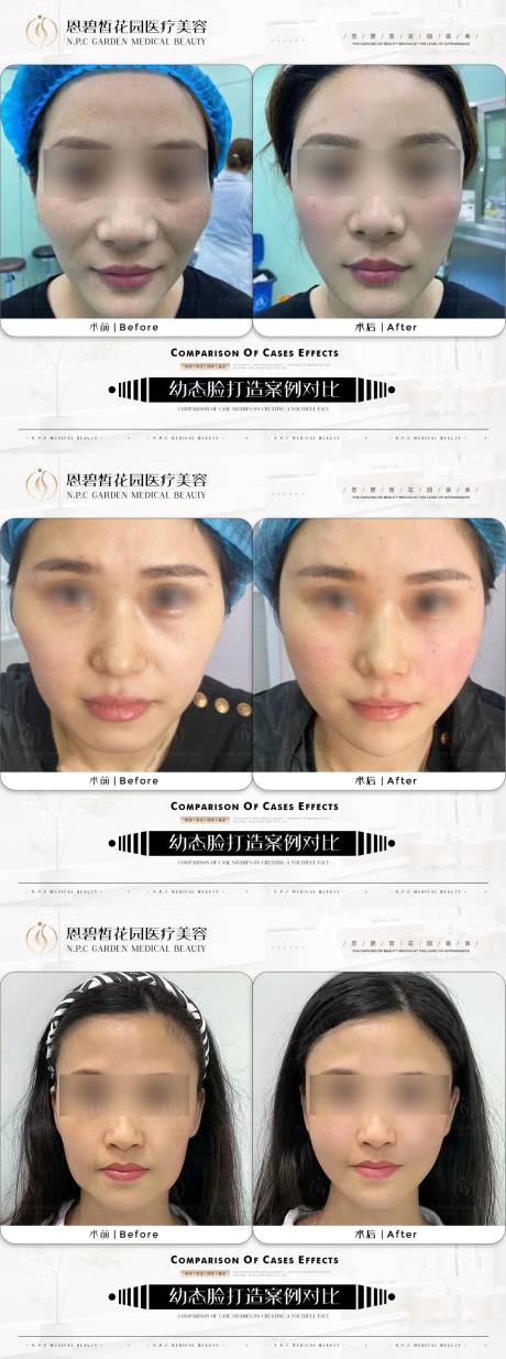 源文件下载【医美幼态脸效果对比】编号：22720020778509586