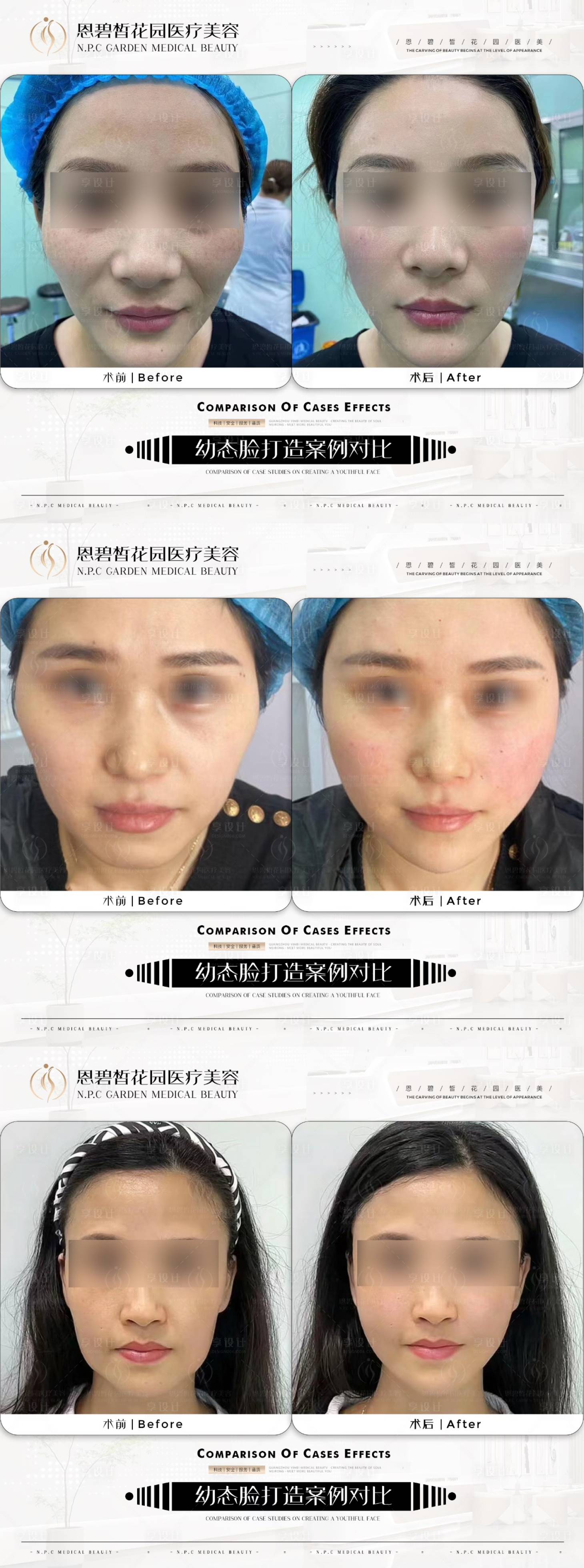 源文件下載【享設(shè)計】搜索編號：22720020778509586【醫(yī)美幼態(tài)臉效果對比】
