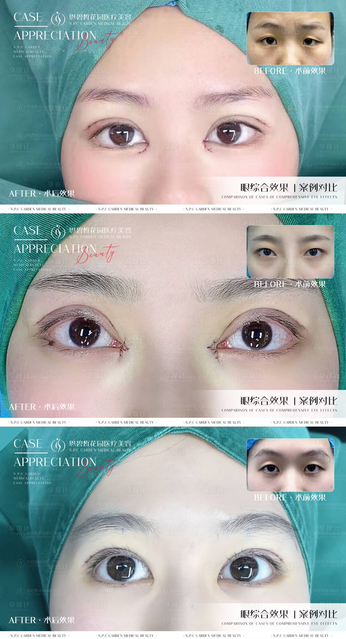 源文件下载【整形医美双眼皮对比效果案例】编号：91460020719513483
