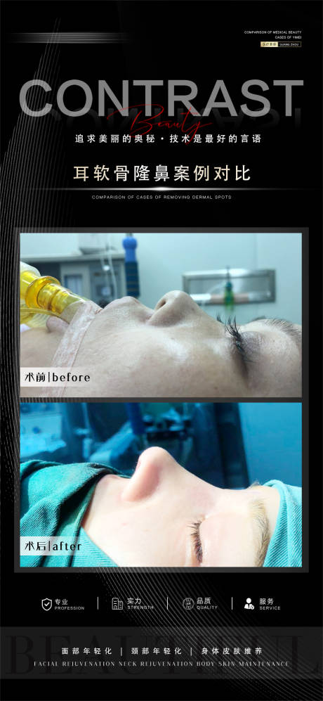 源文件下载【医美隆鼻案例海报】编号：14140021164871618