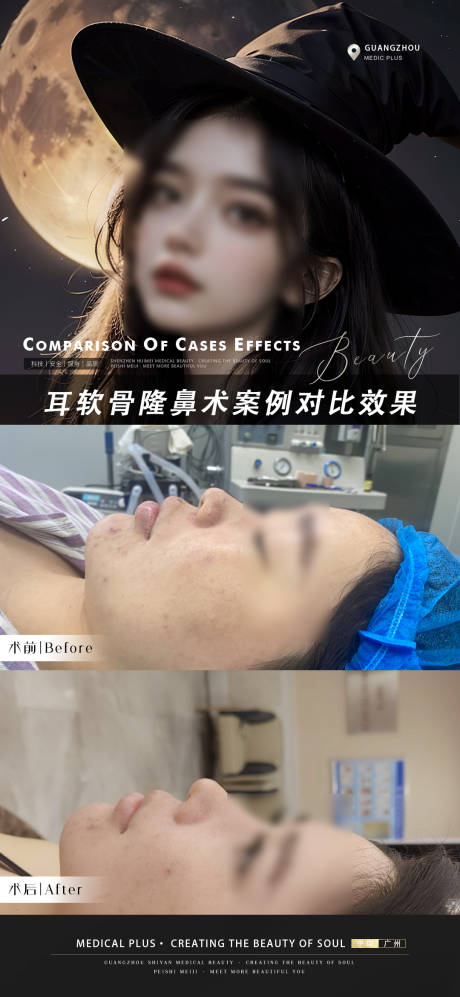 源文件下载【医美隆鼻案例海报】编号：49780021148952435