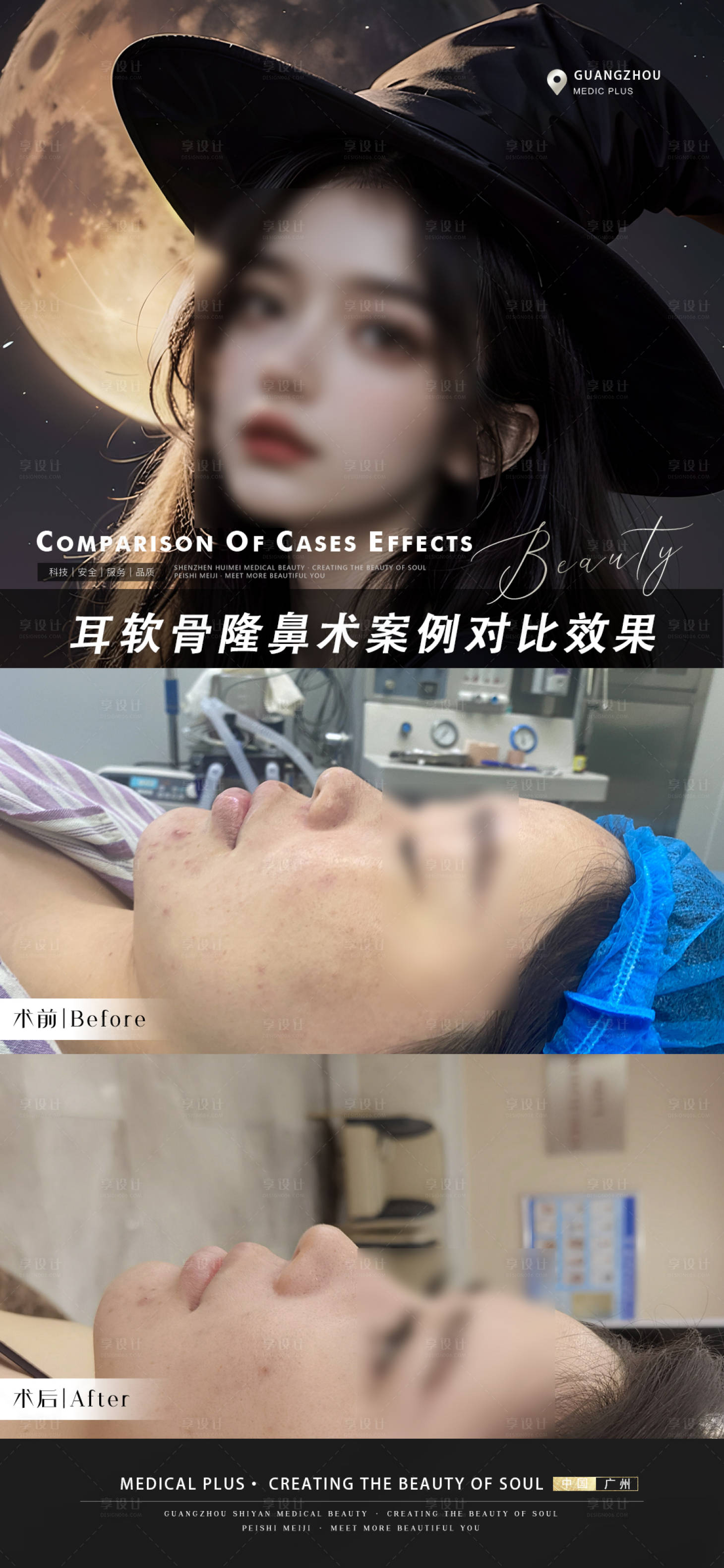 源文件下載【享設計】搜索編號：49780021148952435【醫美隆鼻案例海報】