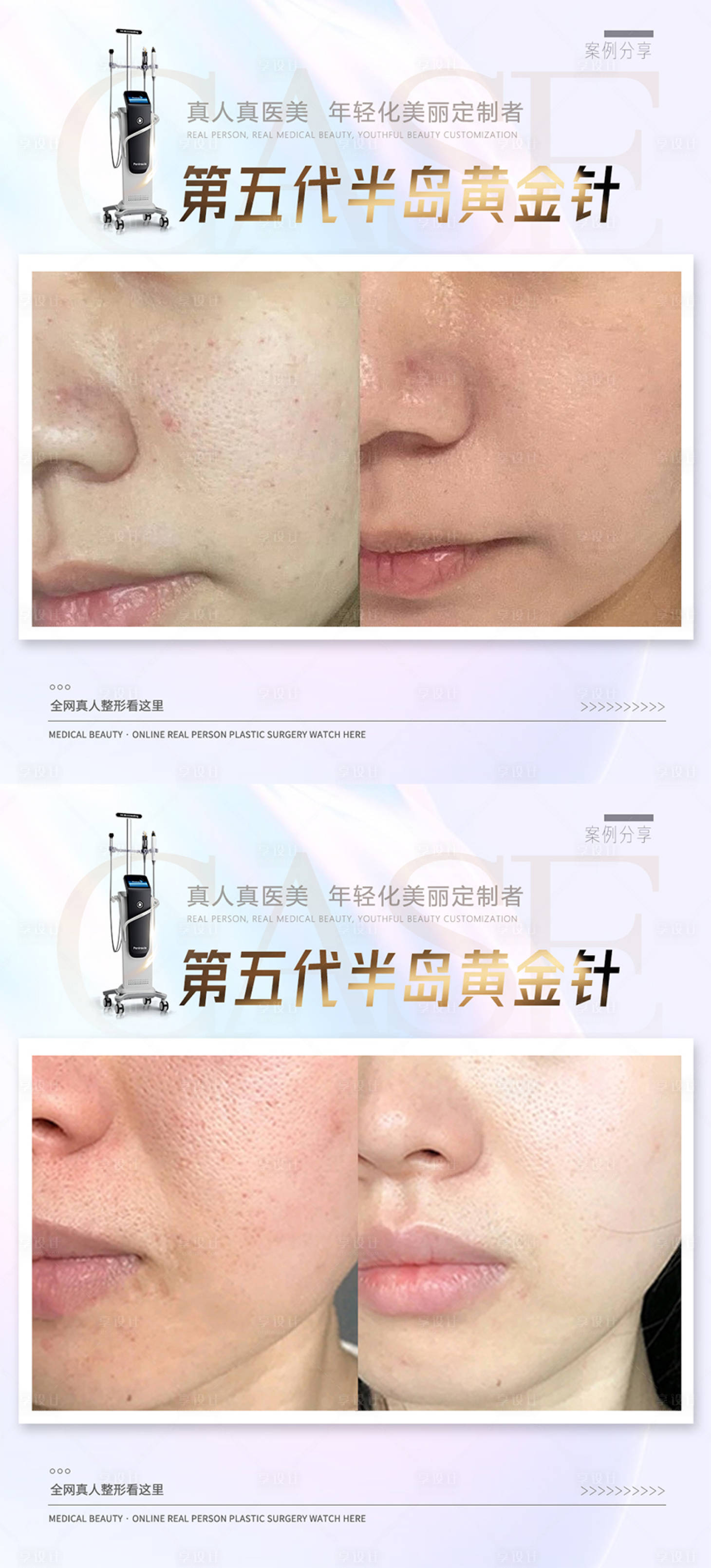 源文件下载【享设计】搜索编号：92130020972685271【黄金微针海报案例图】