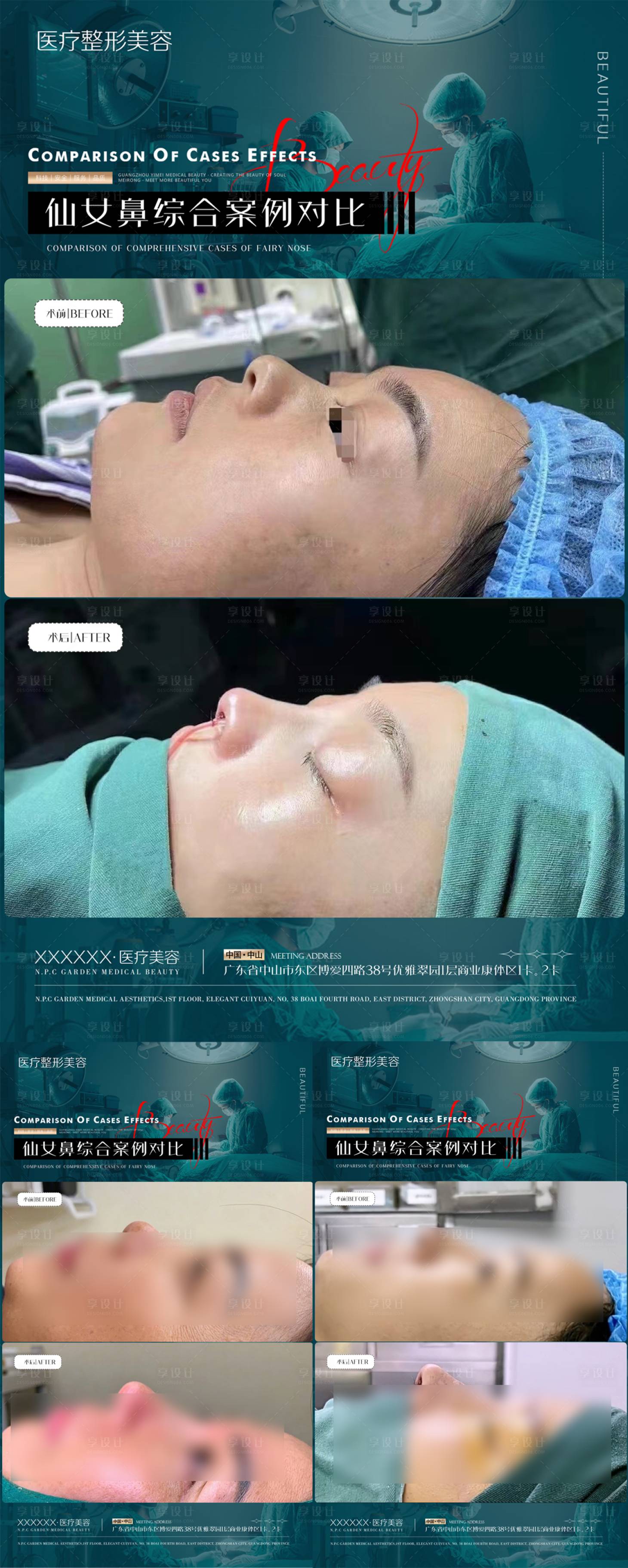 源文件下载【享设计】搜索编号：55680020986938521【医美隆鼻案例海报】