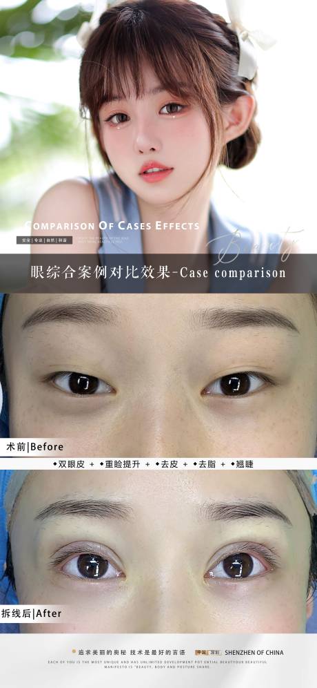 源文件下载【医美案例双眼皮】编号：81650020750742355