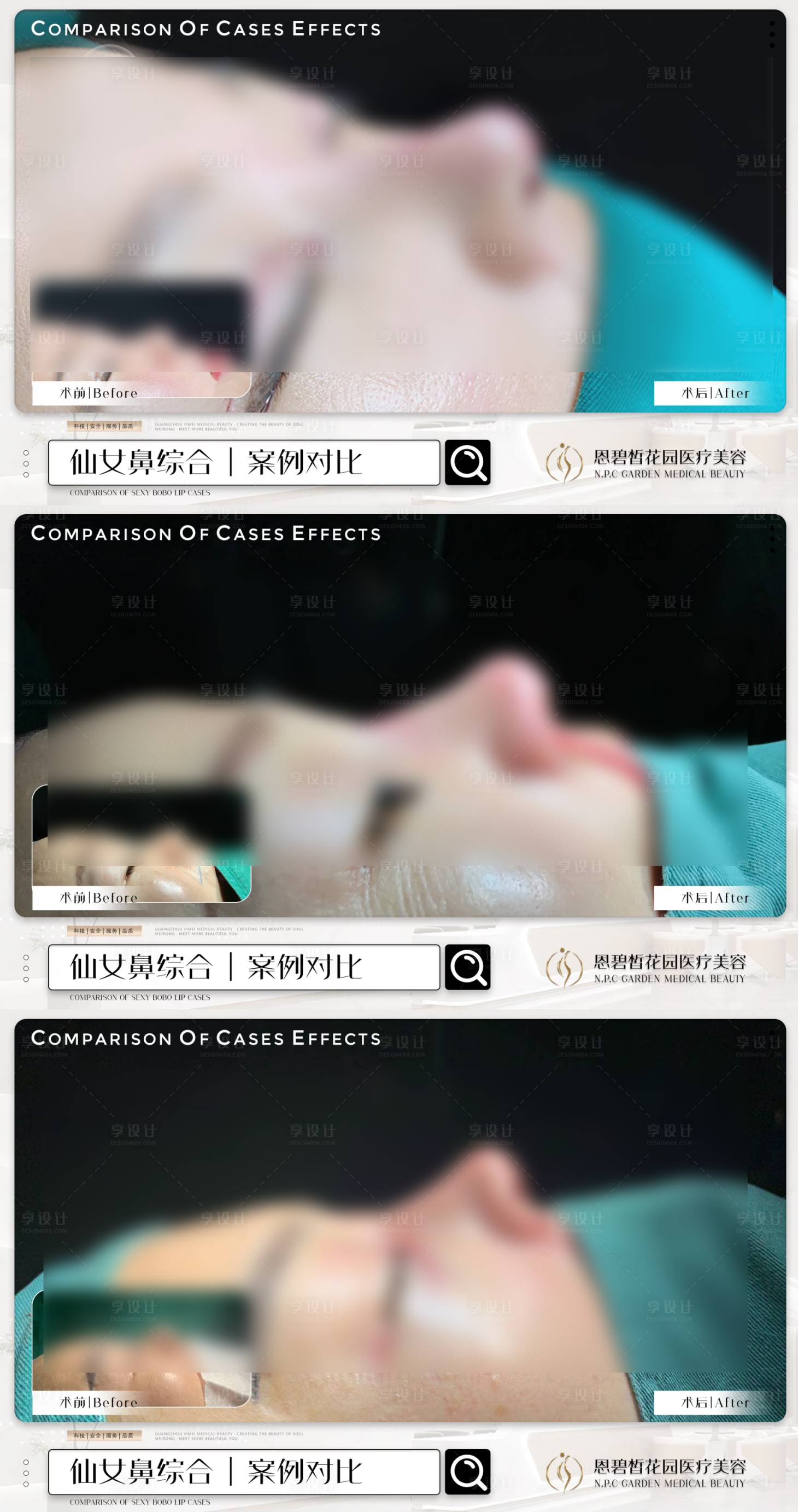 源文件下载【享设计】搜索编号：89730020826096601【医美隆鼻效果对比海报】