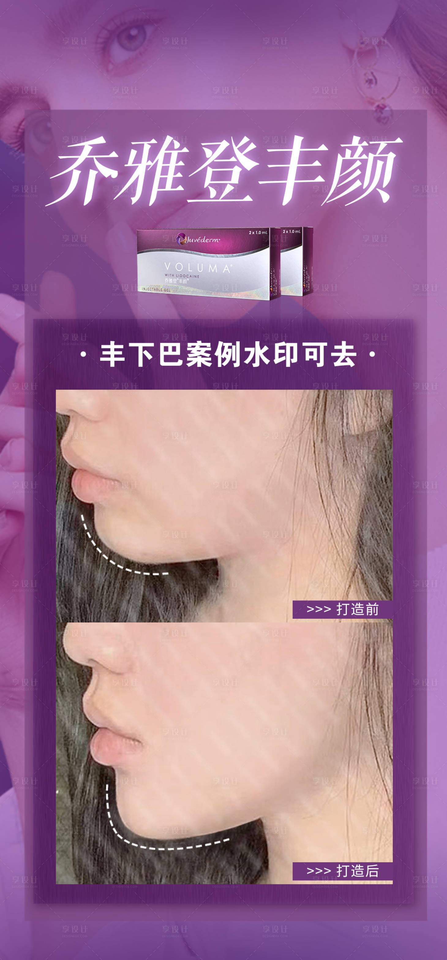 源文件下载【享设计】搜索编号：75560020777995088【乔雅登玻尿酸丰下巴案例】