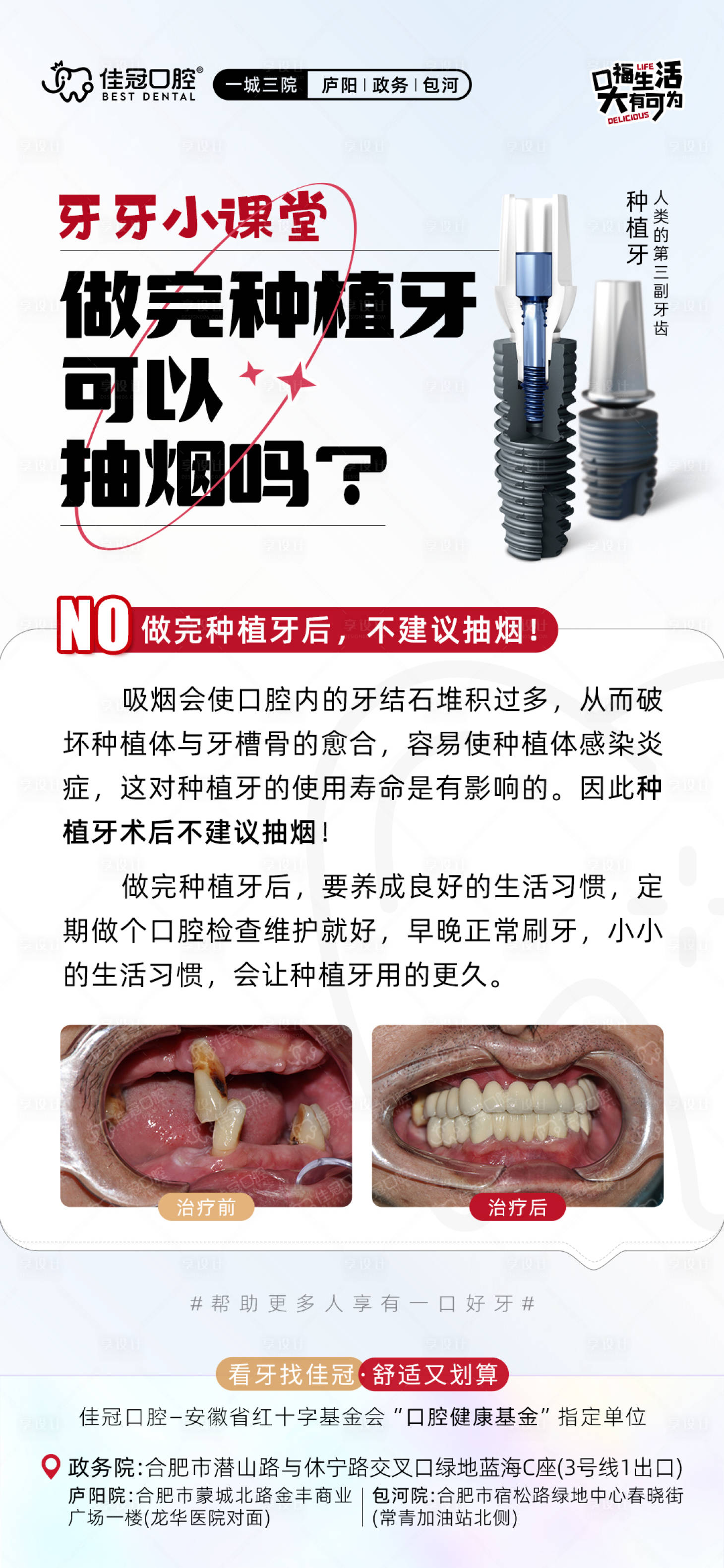 源文件下載【享設計】搜索編號：67970020975768141【種植牙術后注意事項海報】