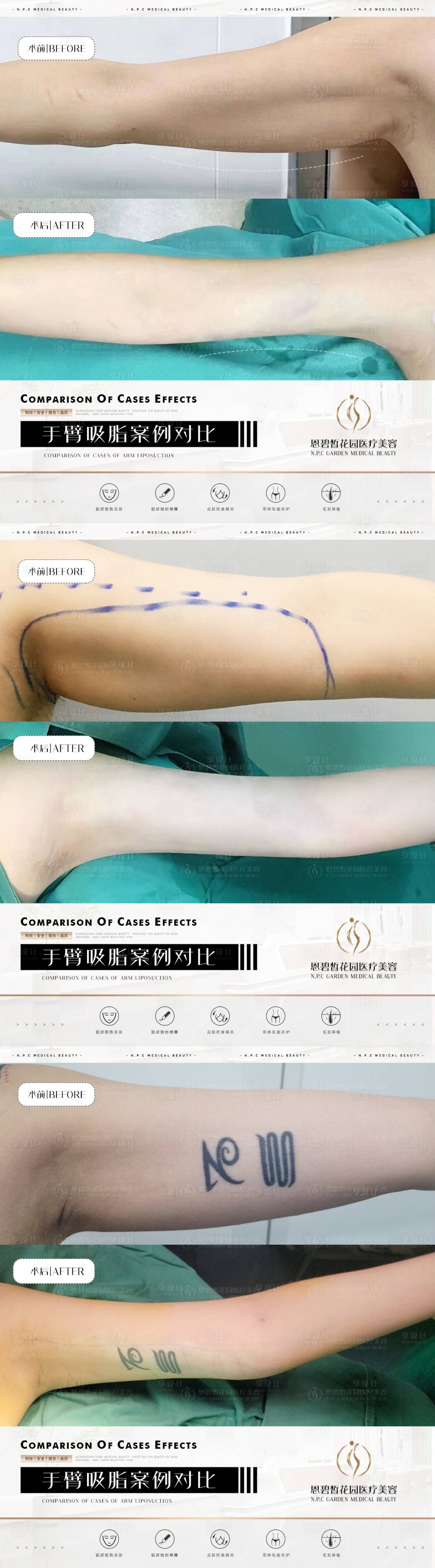 源文件下载【医美手臂吸脂案例海报】编号：94190020718913292