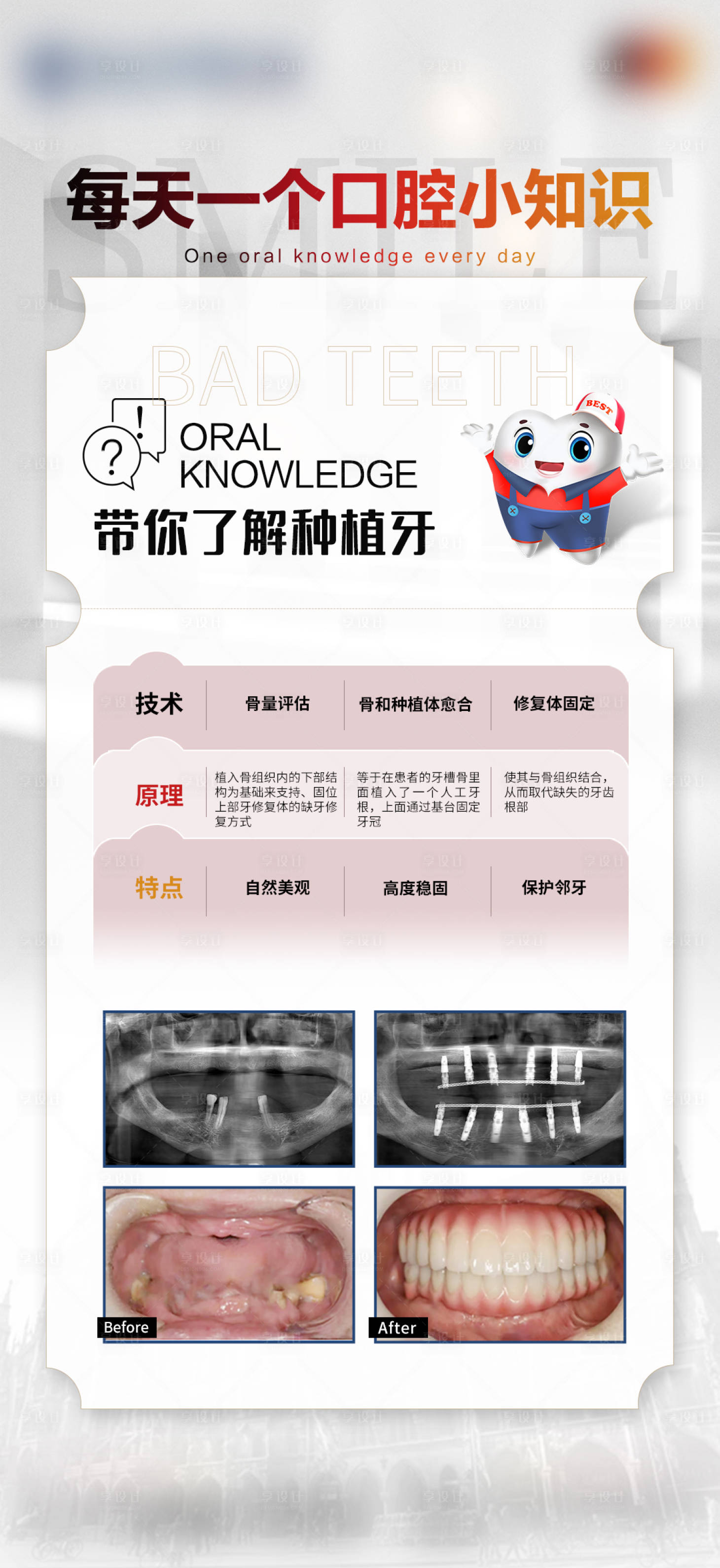 源文件下載【享設計】搜索編號：72920020756965733【醫美口腔種植牙科普海報】
