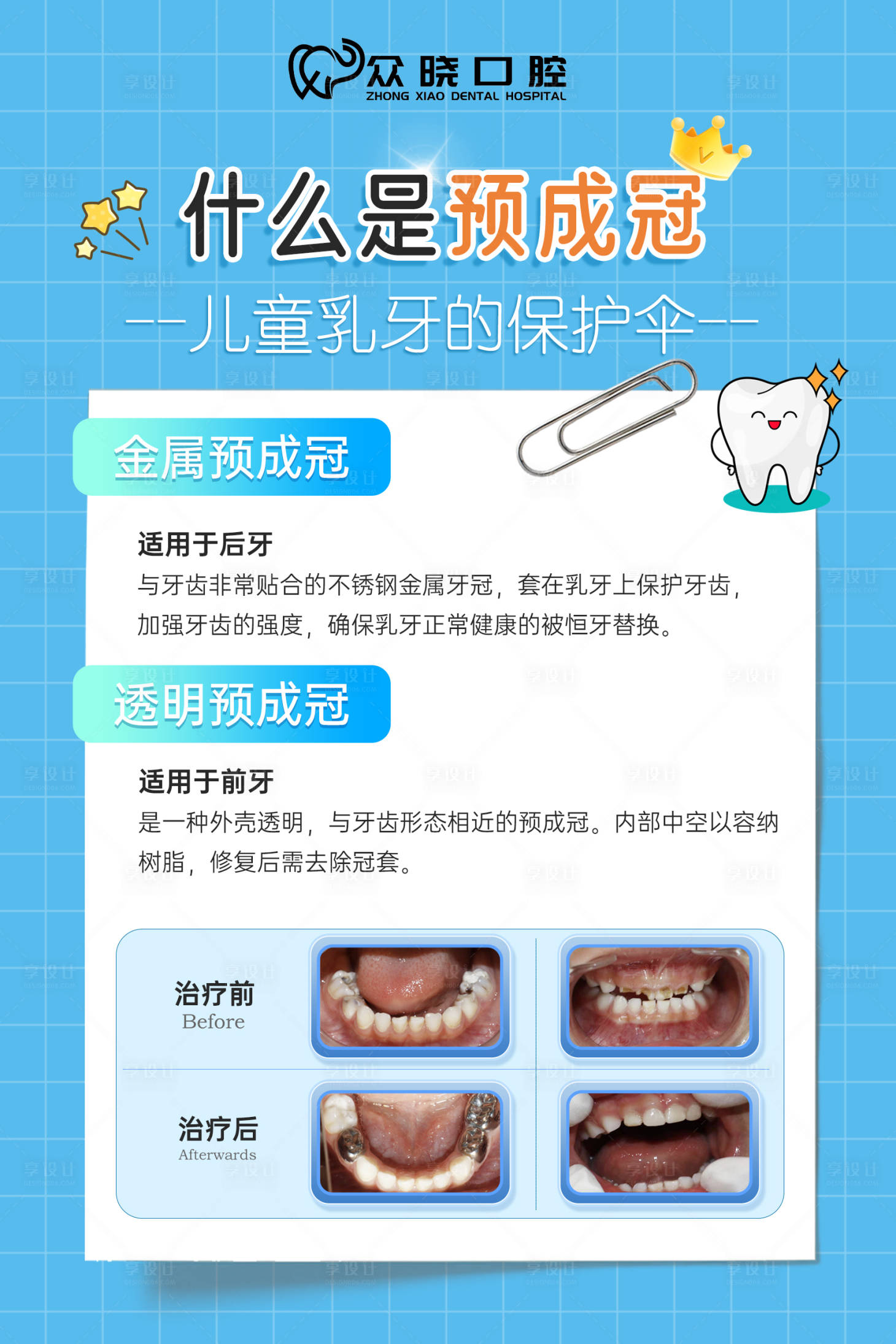 源文件下載【享設計】搜索編號：26090020979221688【口腔預成冠科普】
