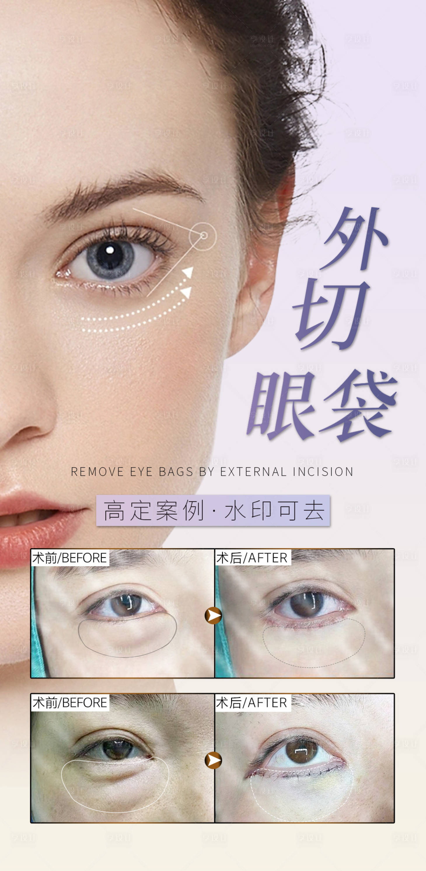 源文件下载【享设计】搜索编号：59730021539153644【外切眼袋整形案例海报】