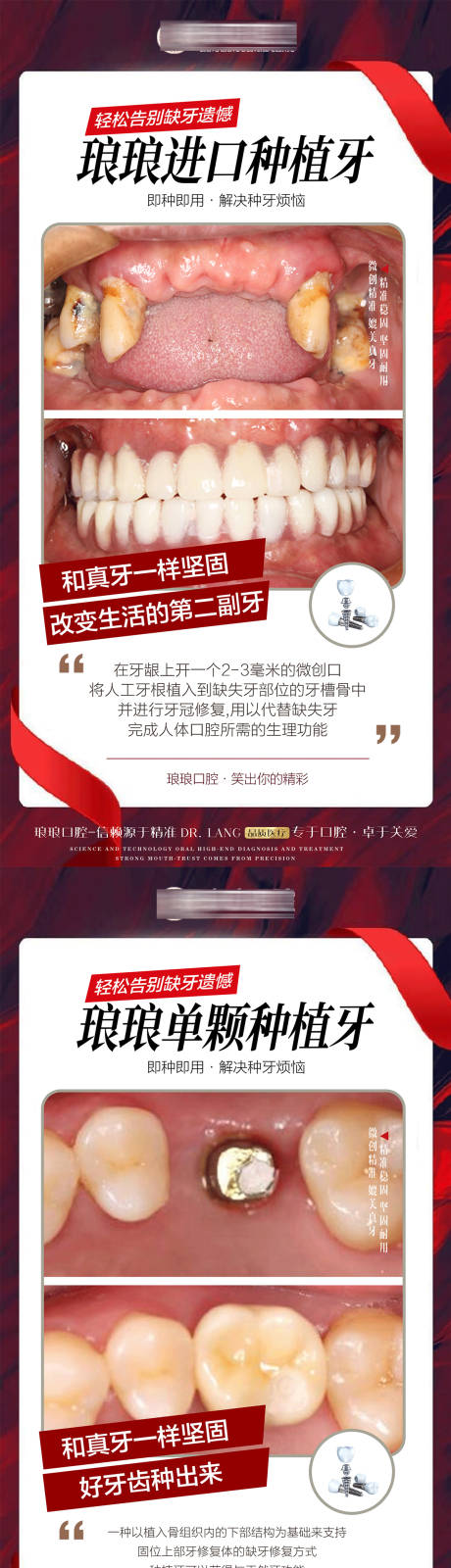 源文件下載【口腔全口單顆種植牙案例海報】編號：17560021315055163