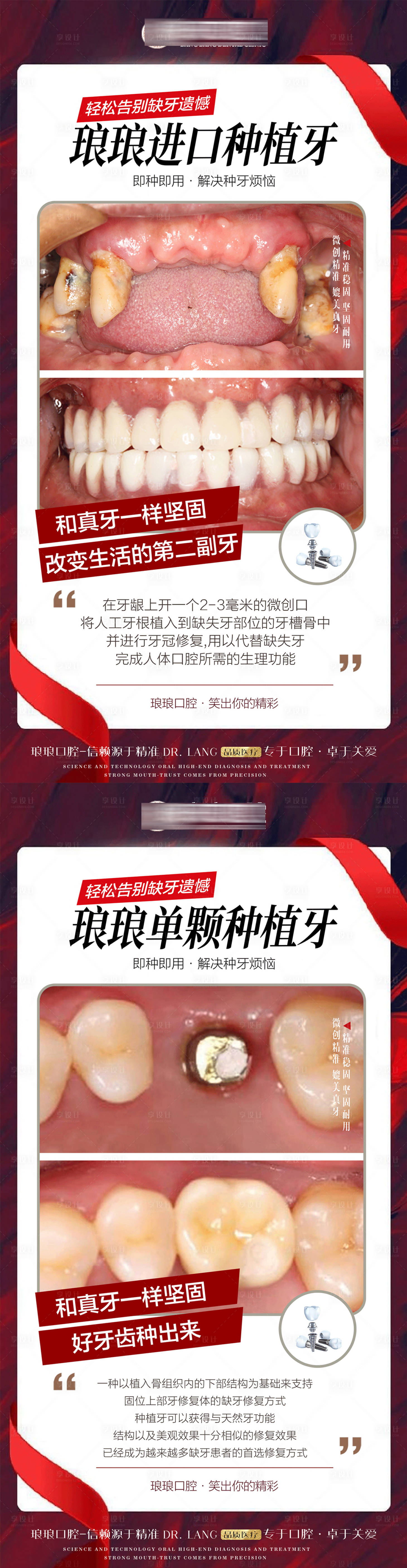 源文件下載【口腔全口單顆種植牙案例海報】編號：17560021315055163