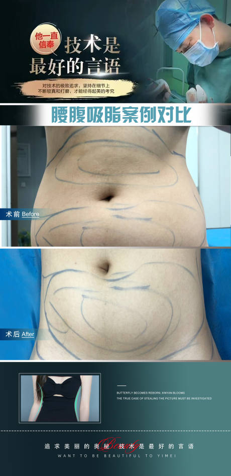 源文件下载【医美腰腹吸脂案例海报】编号：46300021343382496