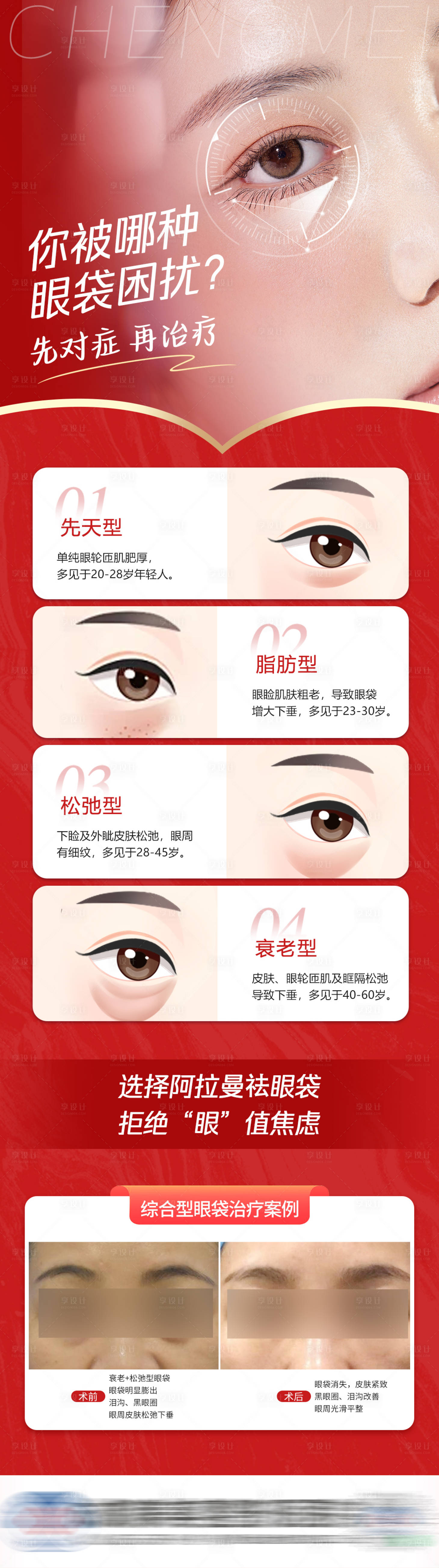 源文件下载【享设计】搜索编号：78370021421335960【医美祛眼袋案例海报】