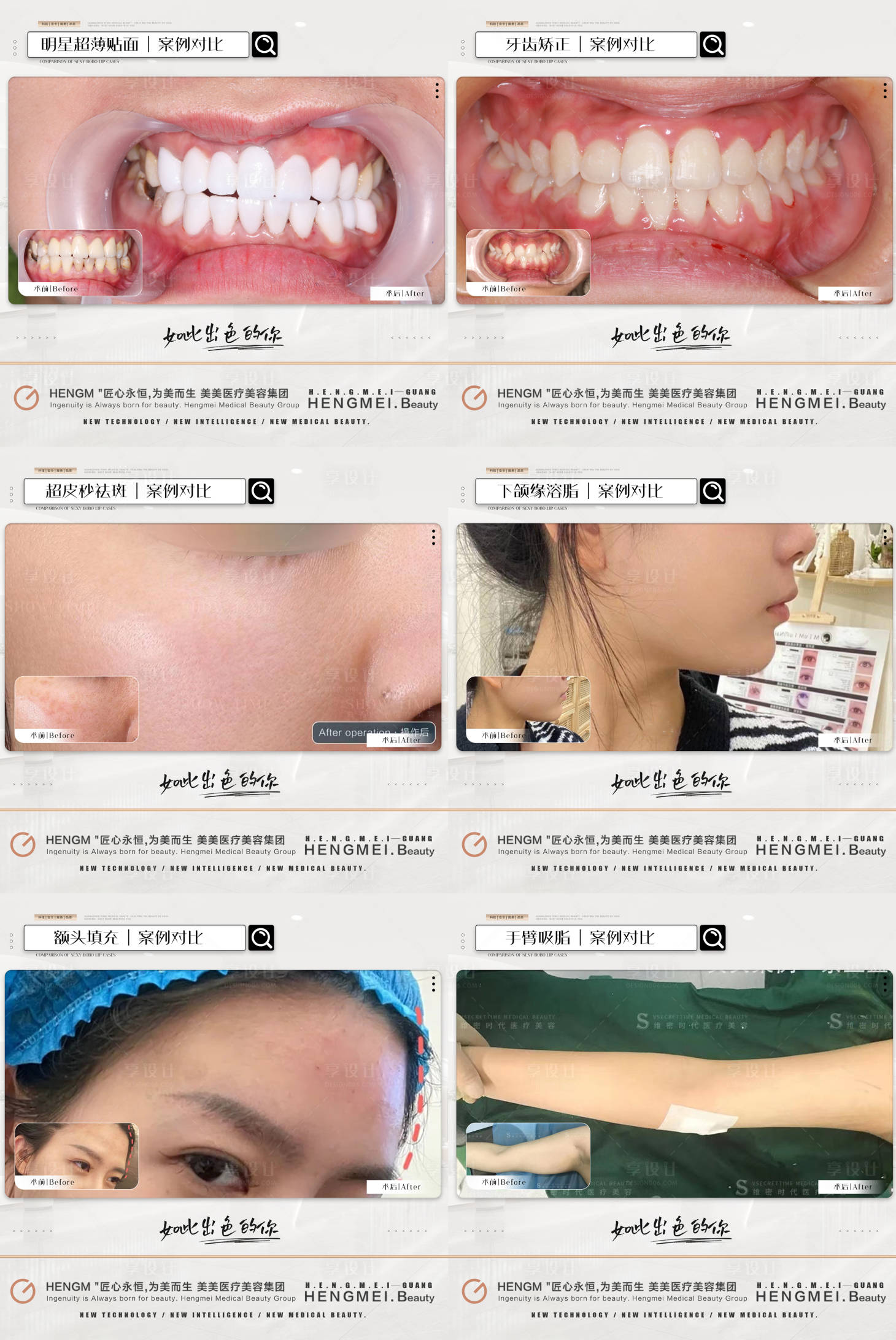 源文件下载【医美整形案例简约系列】编号：91570021405209936