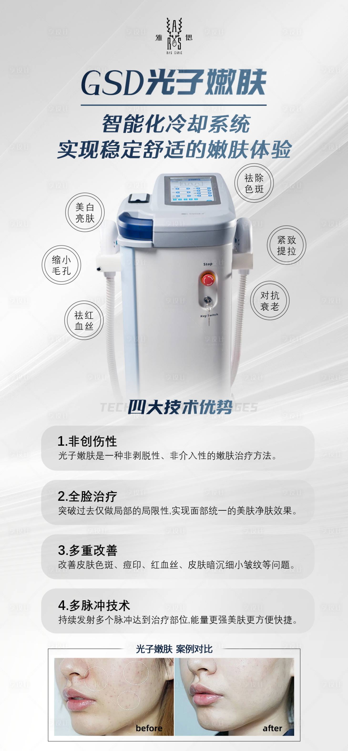 源文件下載【享設計】搜索編號：56970021716539729【醫美光子嫩膚儀器科普對比海報】