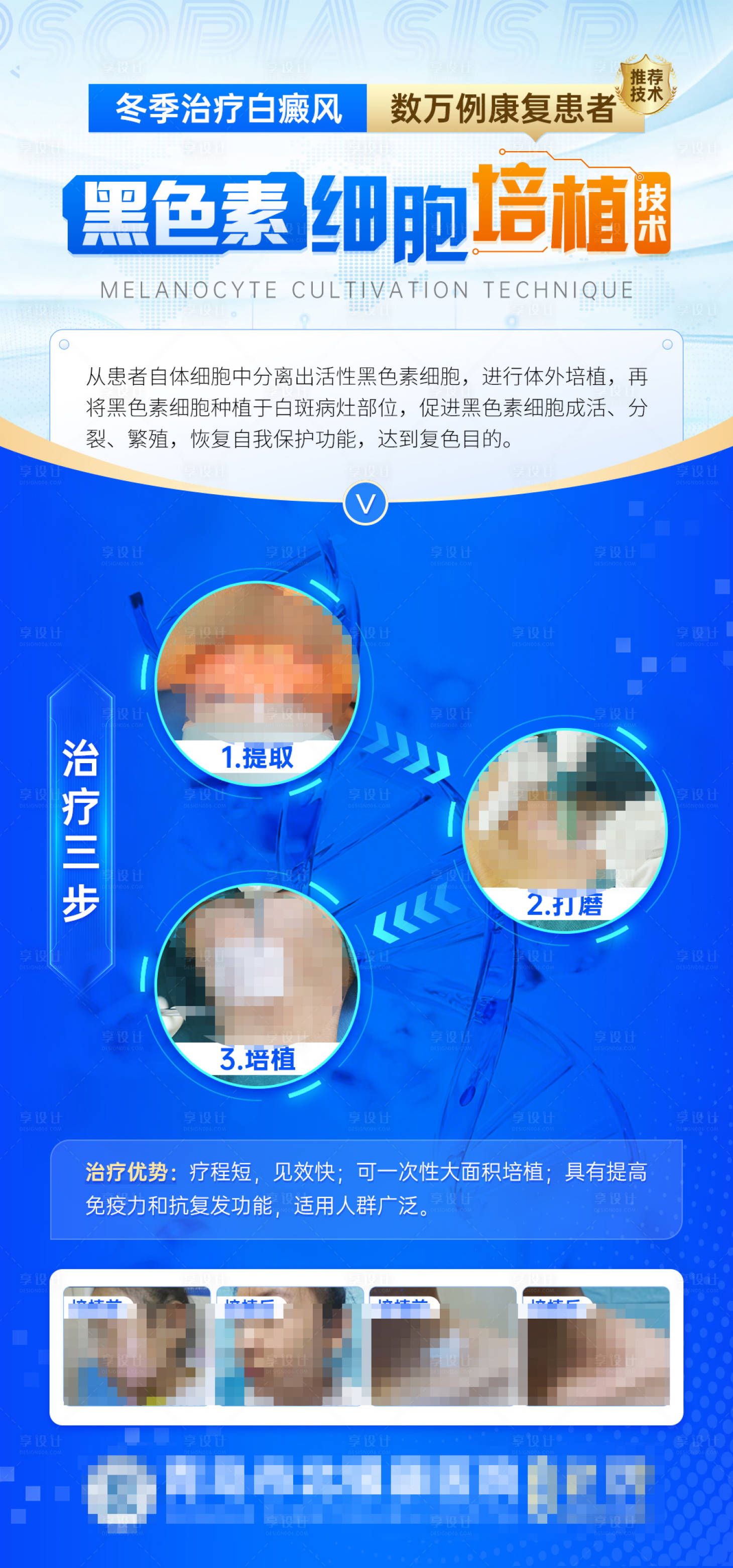 源文件下载【黑色素细胞培植术海报】编号：54540021588469996