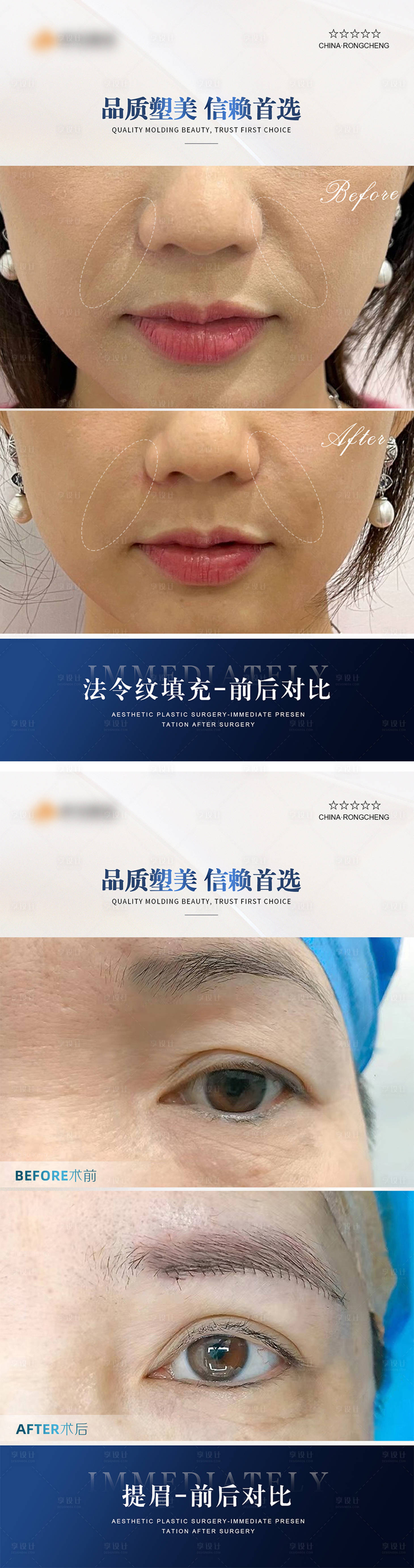 源文件下載【享設計】搜索編號：76270021909586840【醫美案例對比海報】