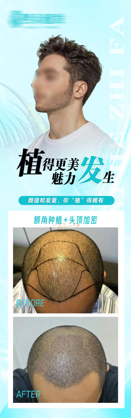 源文件下载【植发案例海报】编号：63230022161482418
