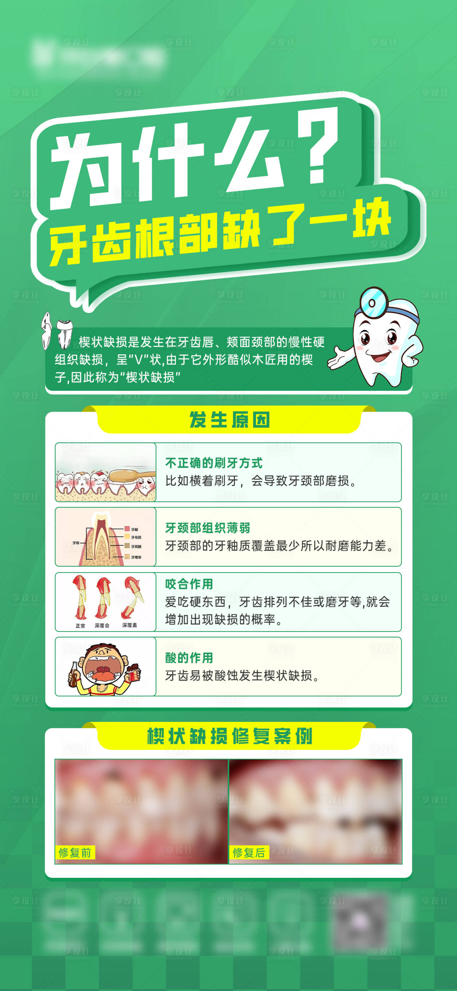 源文件下載【享設計】搜索編號：17200021849402121【牙齒楔狀缺損科普案例海報】