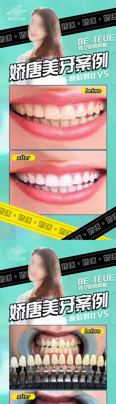 医美牙齿美容案例对比