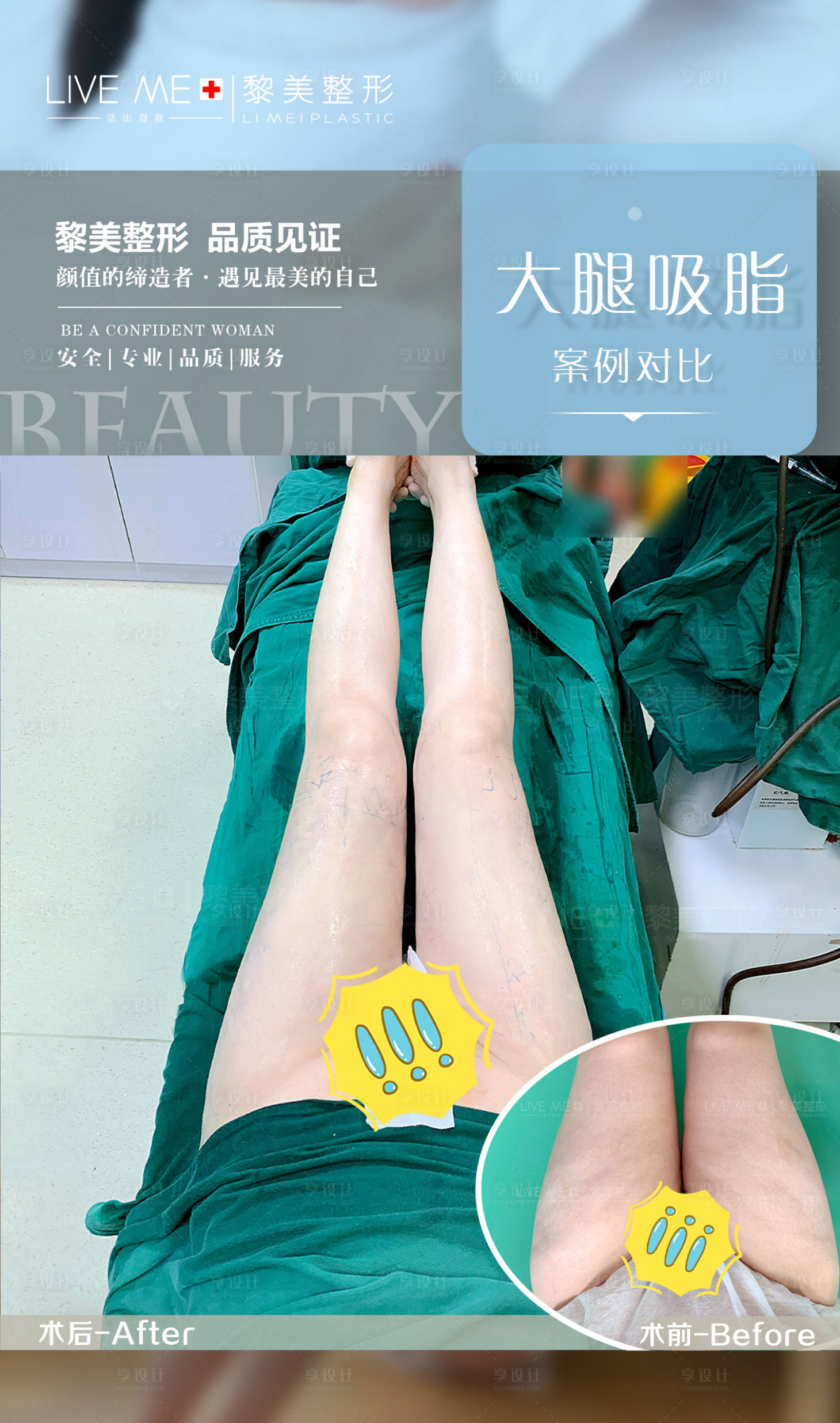 源文件下載【享設計】搜索編號：98570022001048602【大腿吸脂案例】