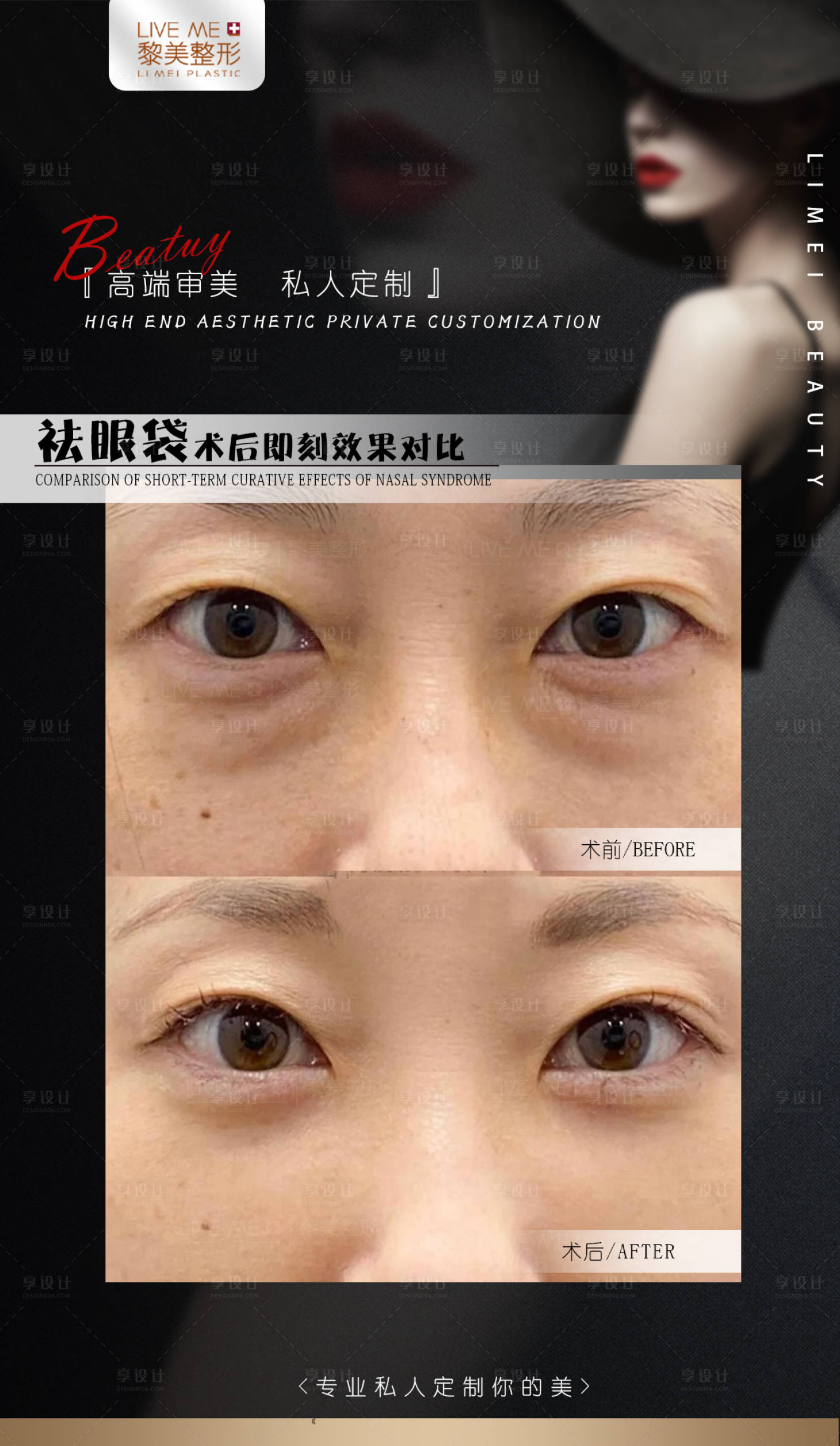 源文件下載【享設計】搜索編號：16740022758278046【祛眼袋案例】