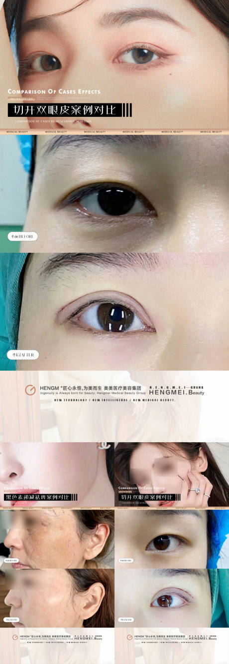 医美双眼皮祛斑案例-源文件【享设计】