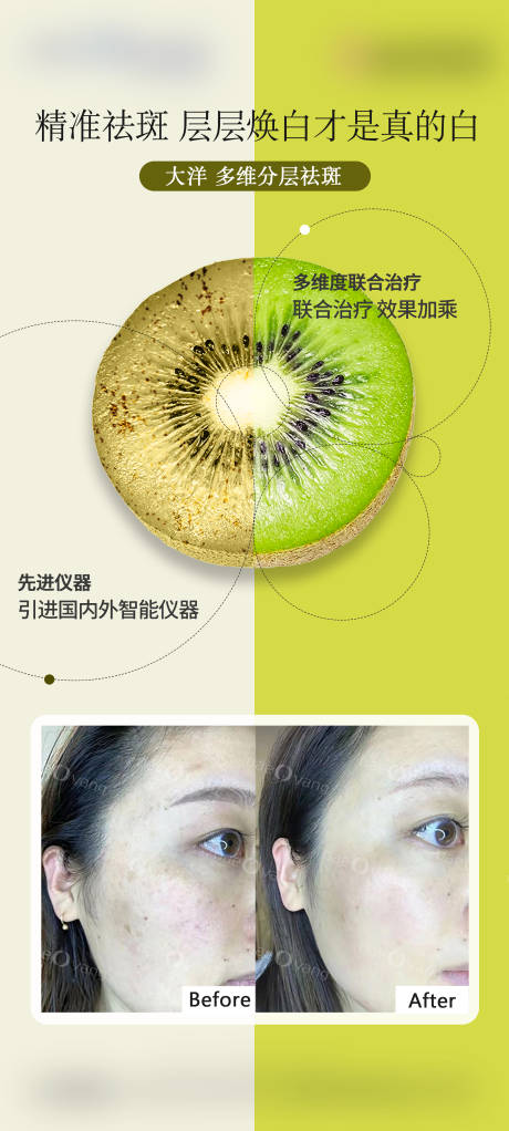 源文件下載【享設(shè)計】搜索編號：54640022692467902【醫(yī)美祛斑皮秒海報】