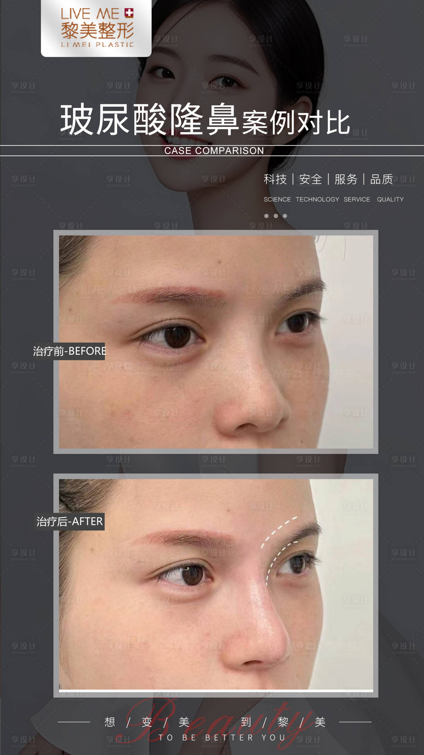 源文件下载【玻尿酸隆鼻案例】编号：26510022654973826
