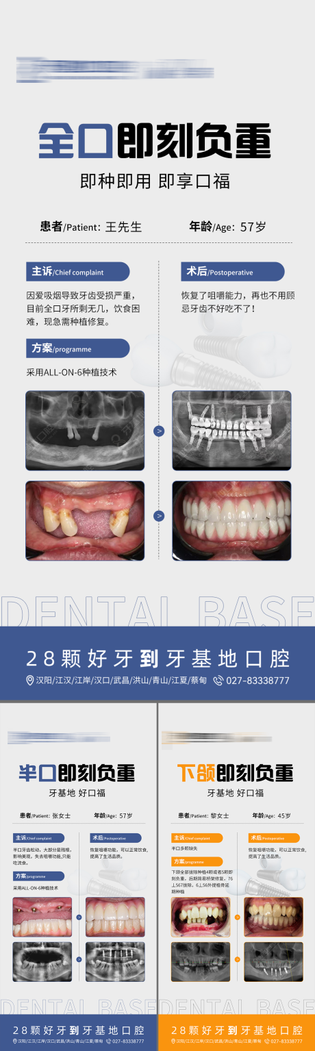 源文件下载【口腔种植案例海报】编号：24030023492246392