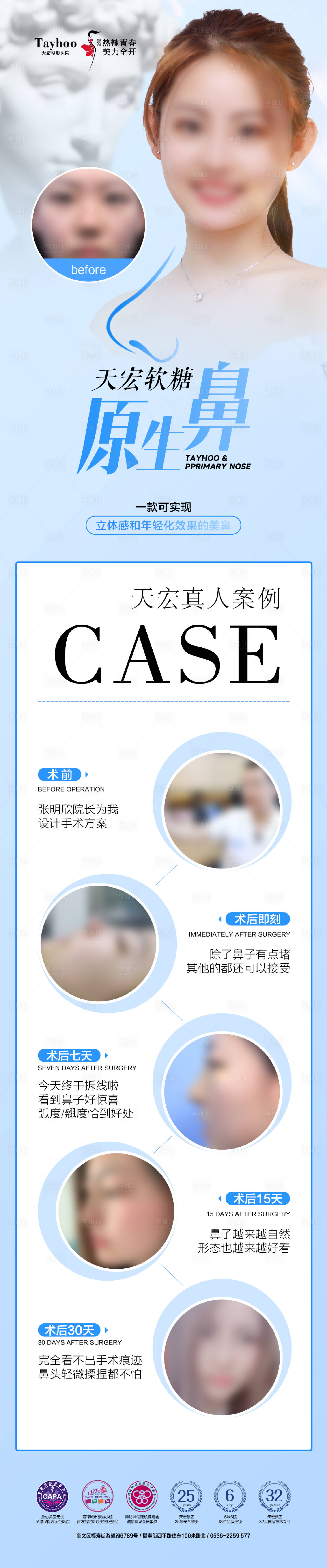 源文件下载【隆鼻过程长图海报】编号：69950023339367646
