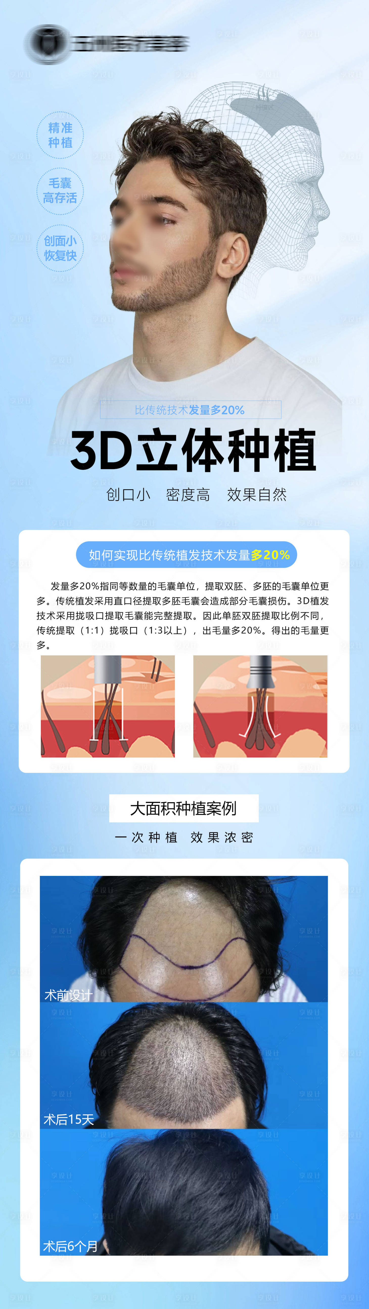 源文件下载【植发3D立体种植海报长图】编号：90320023110038737