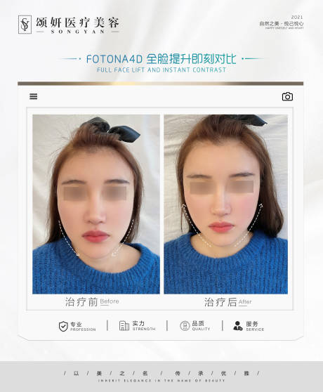 源文件下载【医美案例对比海报】编号：82470023295155531