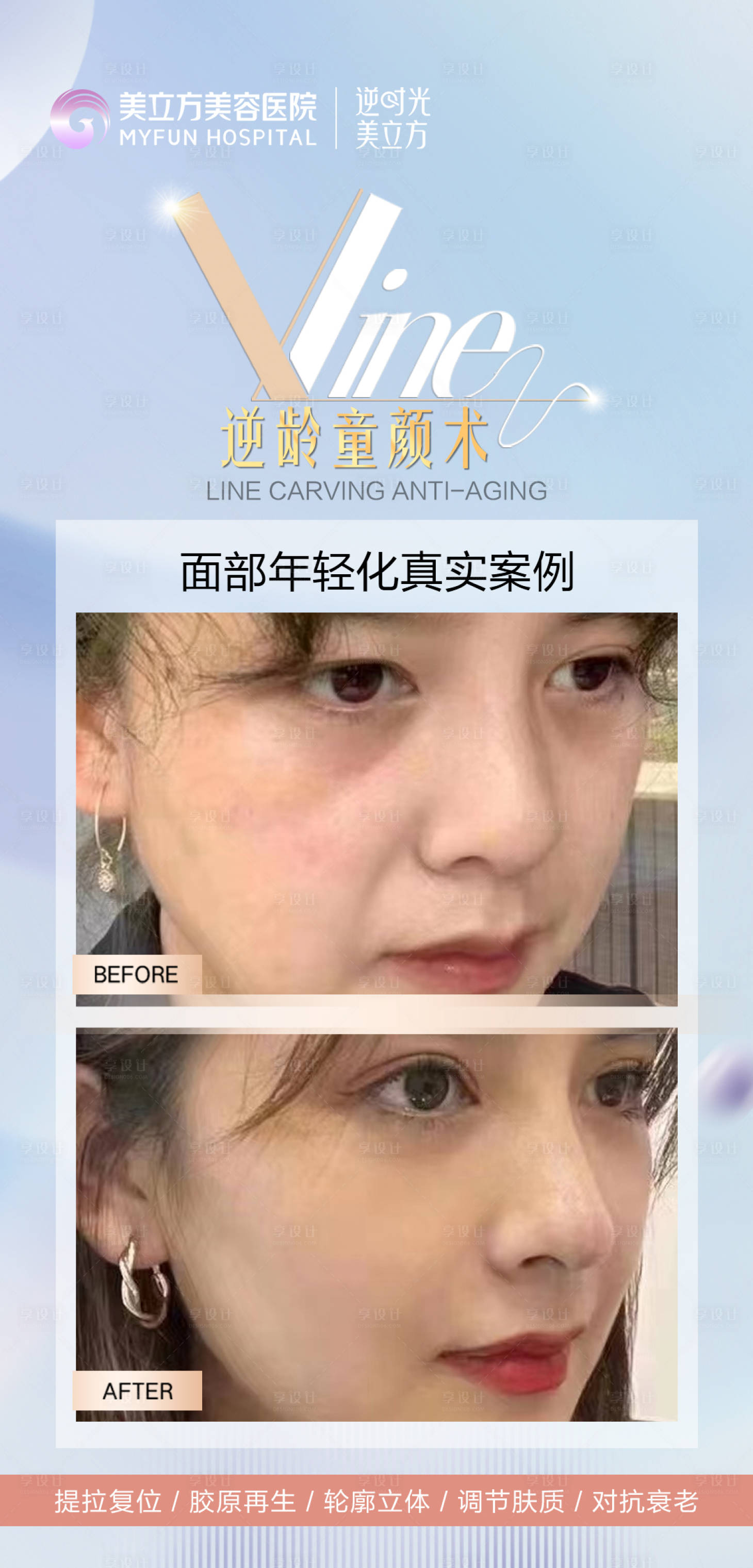源文件下載【享設計】搜索編號：47320023156709413【醫美抗衰逆齡童顏術線雕案例面部年輕化】