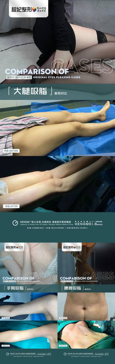 医美腰腹大腿手臂吸脂案例-源文件【享设计】