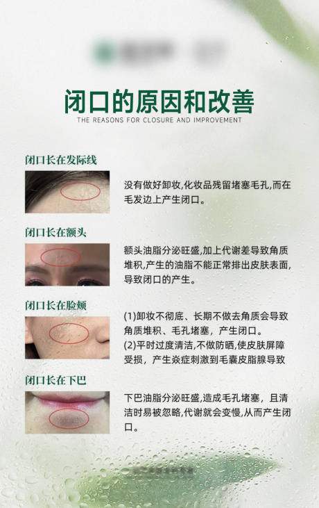 源文件下载【肌肤闭口痘痘科普海报】编号：42650023265499309