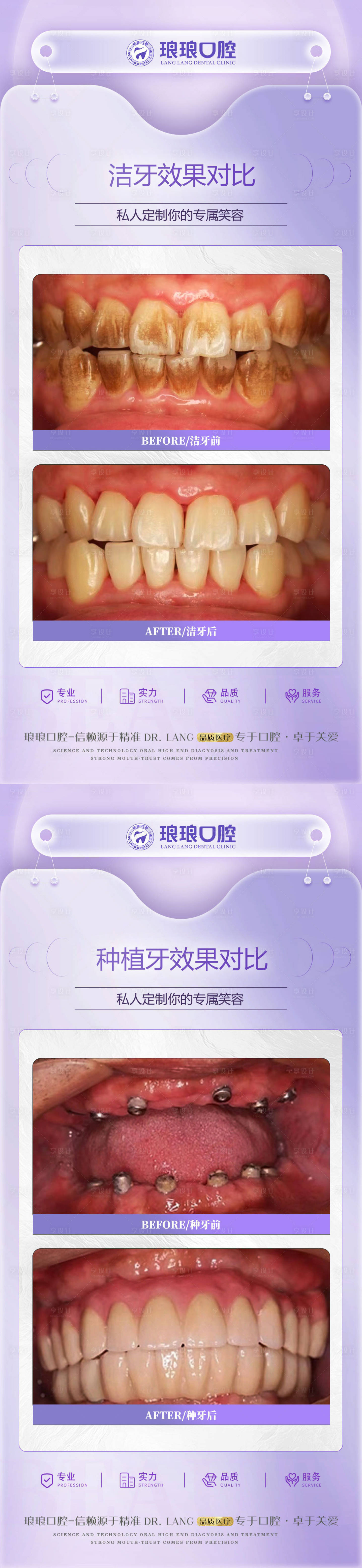 源文件下载【享设计】搜索编号：51550023021616351【种牙洗牙案例对比海报】