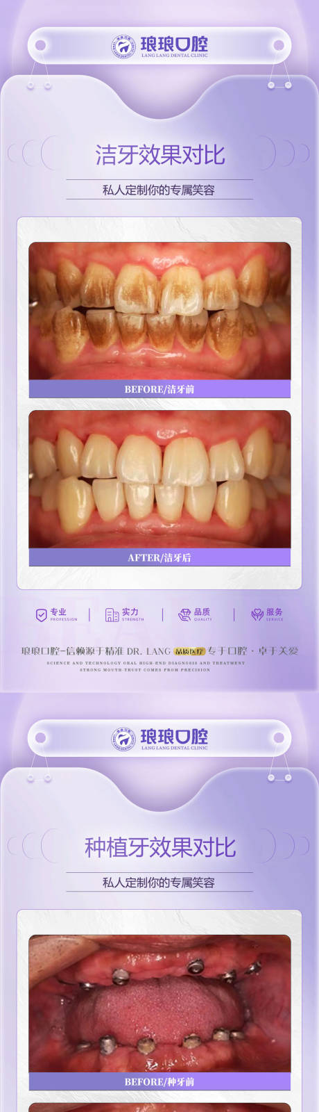 编号：51550023021616351【享设计】源文件下载-种牙洗牙案例对比海报