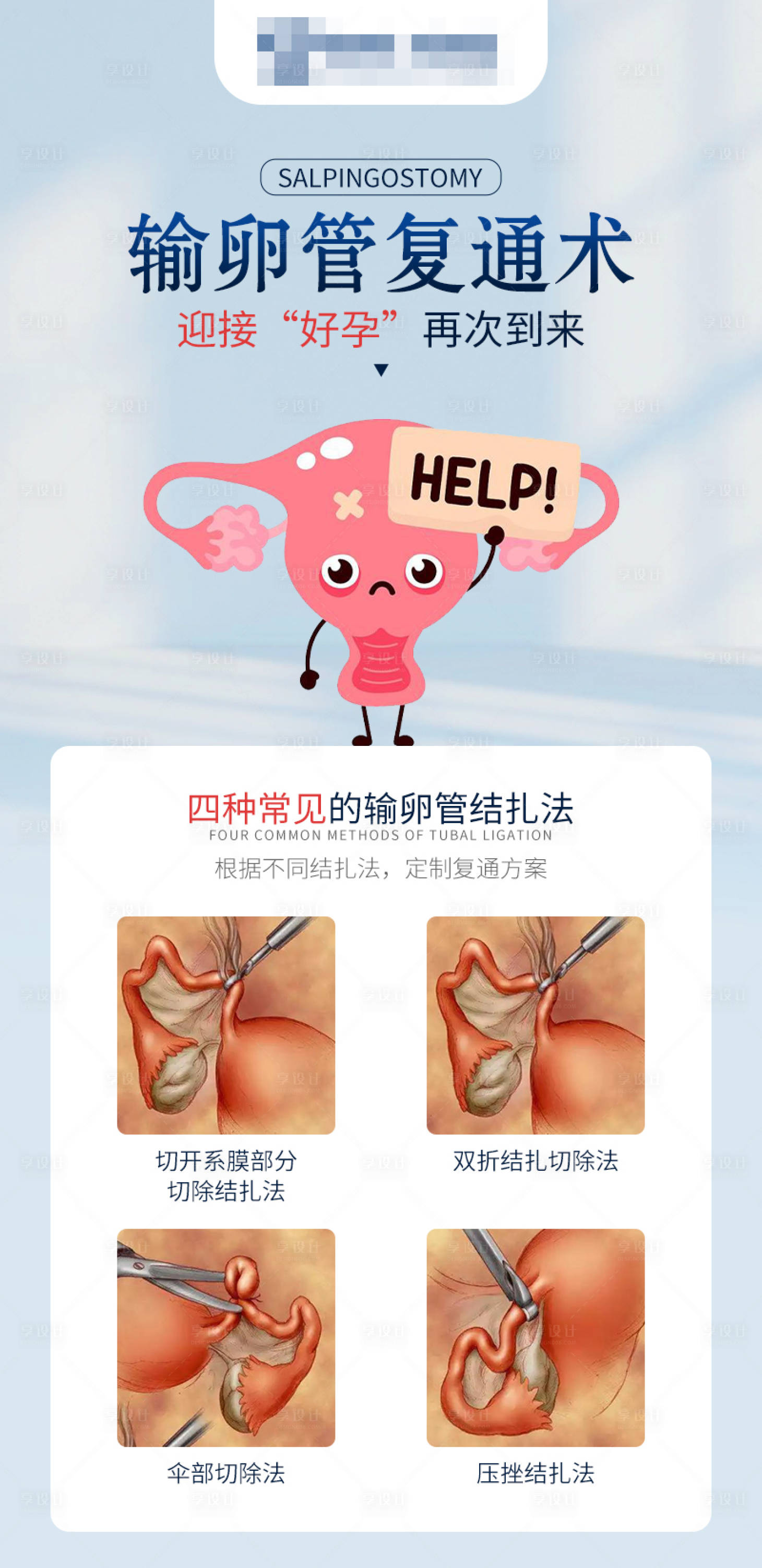 源文件下载【享设计】搜索编号：48040024030105976【四种常见的输卵管结扎方式】